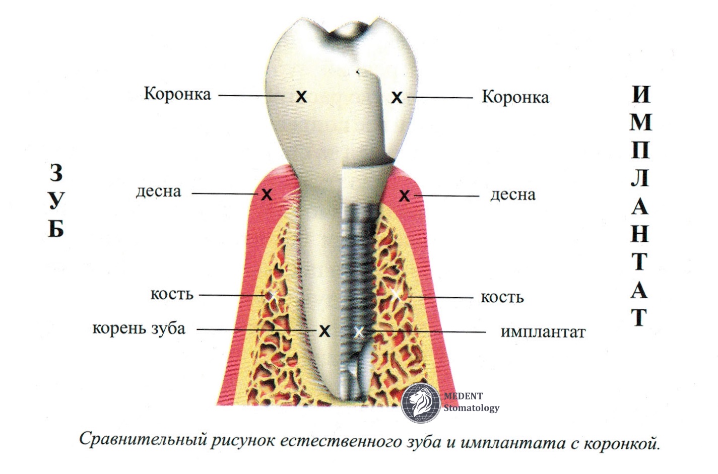 Какую функцию выполняет коронка зуба. Как ставятся штифты зубные. Строение штифта. Схема установки коронки. Строение зуба.